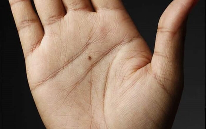 khám phá, nốt ruồi đỏ ở tay mang ý nghĩa gì? có nên tẩy xóa không?