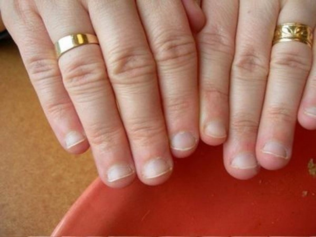 nail đẹp, móng tay bị vểnh lên có bất thường? cách khắc phục móng vểnh