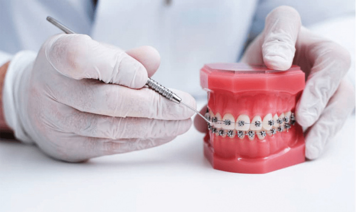dịch vụ, top 3 phương pháp niềng răng tốt nhất hiện nay