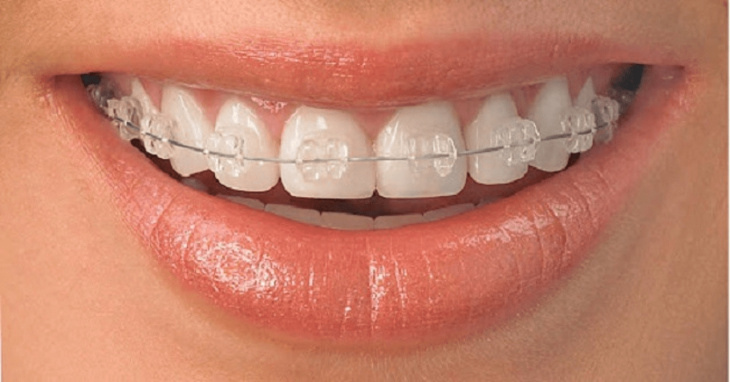 dịch vụ, top 3 phương pháp niềng răng tốt nhất hiện nay