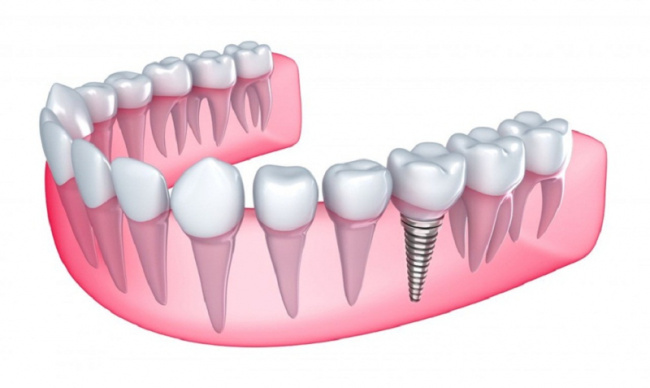 top 11 địa chỉ trồng  răng implant uy tín nhất quận 10, tp hcm