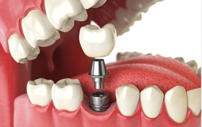 top 11 địa chỉ trồng  răng implant uy tín nhất quận 10, tp hcm