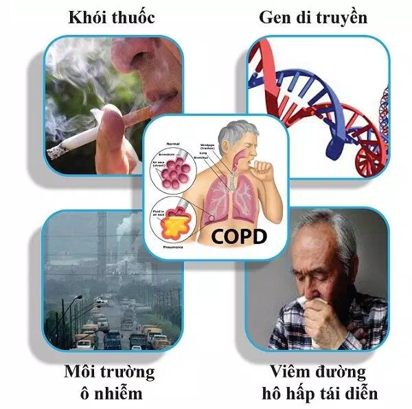 Dinh dưỡng cho người mắc bệnh phổi tắc nghẽn mạn tính (COPD) cần lưu ý điều gì?